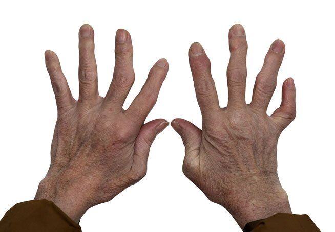 How Hand Therapy Can Help Arthritis — Without Relying Only on Medication