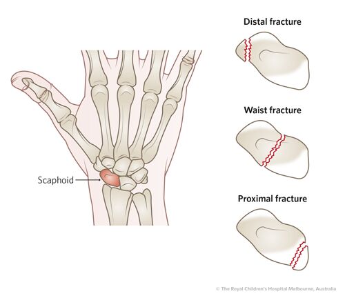 The 5 Most Common Hand Injuries We Treat (and How We Help)