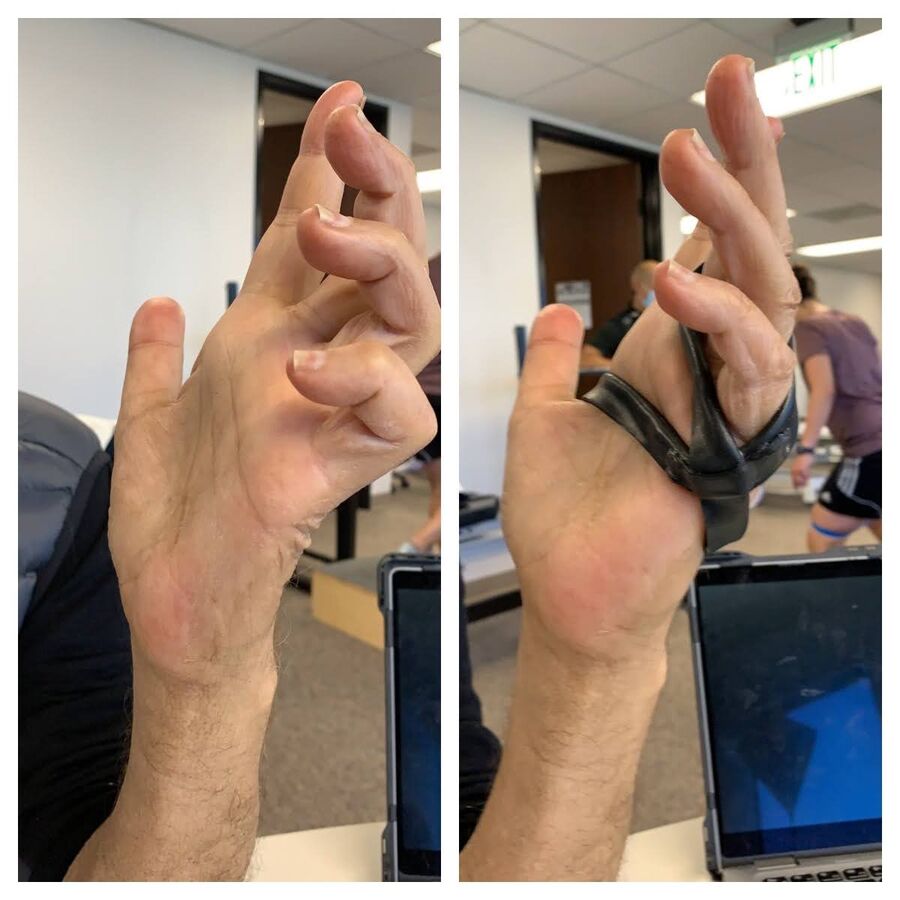 Custom hand orthosis example — thermoplastic splint made at Reach Beyond Therapy in Redondo Beach