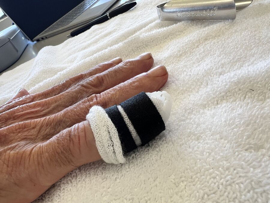Custom hand orthosis example — thermoplastic splint made at Reach Beyond Therapy in Redondo Beach