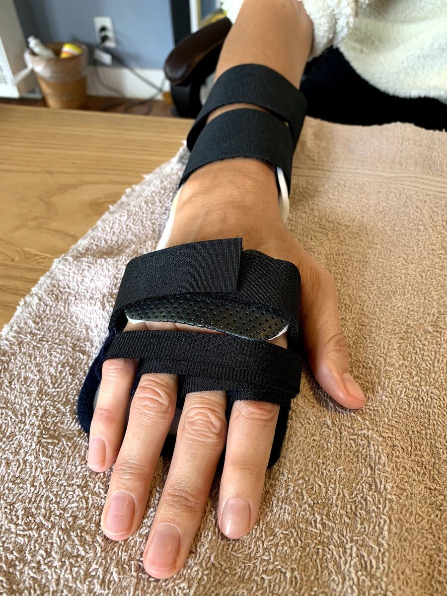 Custom hand orthosis example — thermoplastic splint made at Reach Beyond Therapy in Redondo Beach