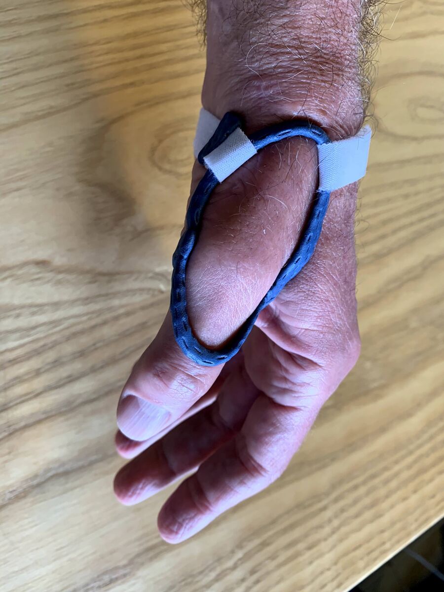 Custom hand orthosis example — thermoplastic splint made at Reach Beyond Therapy in Redondo Beach