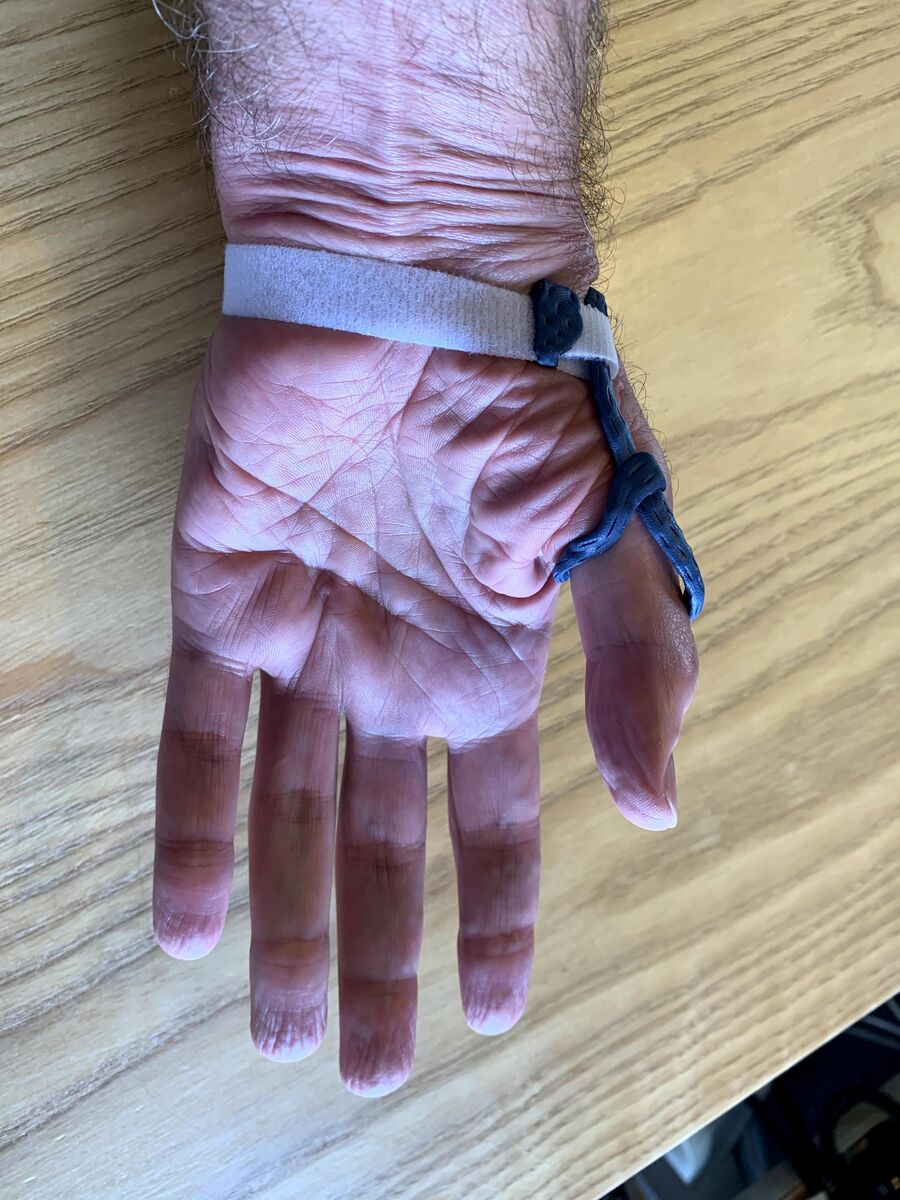 Custom hand orthosis example — thermoplastic splint made at Reach Beyond Therapy in Redondo Beach