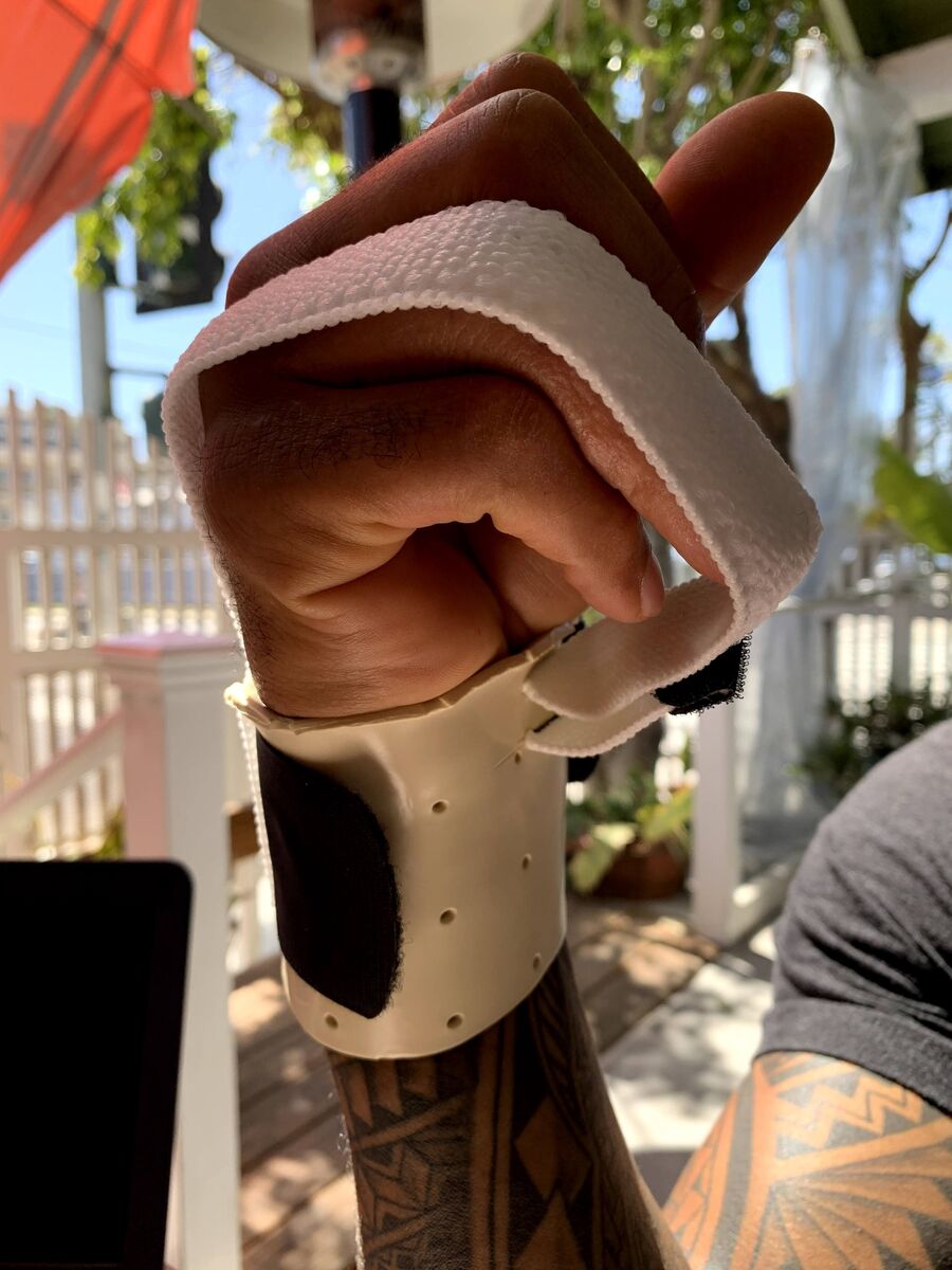 Custom hand orthosis example — thermoplastic splint made at Reach Beyond Therapy in Redondo Beach