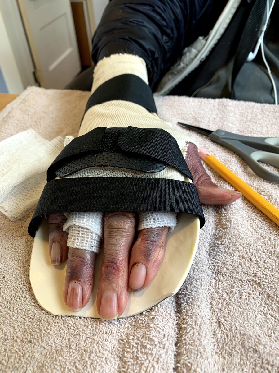 Custom hand orthosis example — thermoplastic splint made at Reach Beyond Therapy in Redondo Beach