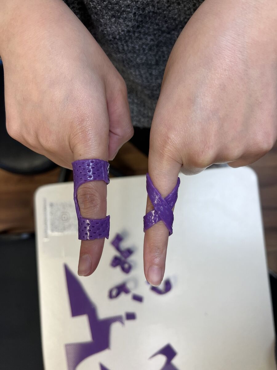 Custom hand orthosis example — thermoplastic splint made at Reach Beyond Therapy in Redondo Beach