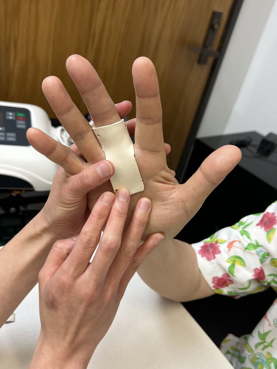Custom hand orthosis example — thermoplastic splint made at Reach Beyond Therapy in Redondo Beach