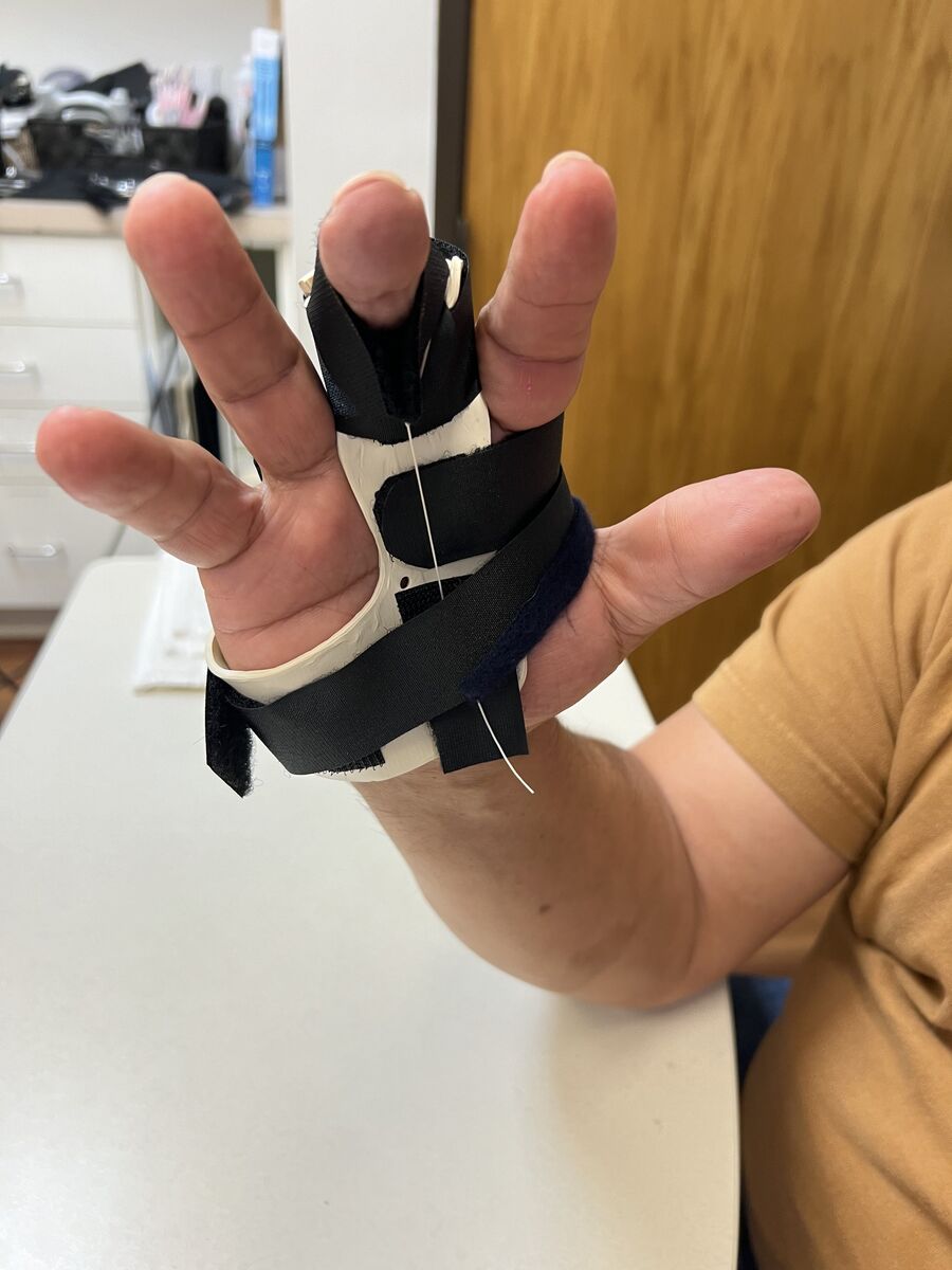 Custom hand orthosis example — thermoplastic splint made at Reach Beyond Therapy in Redondo Beach