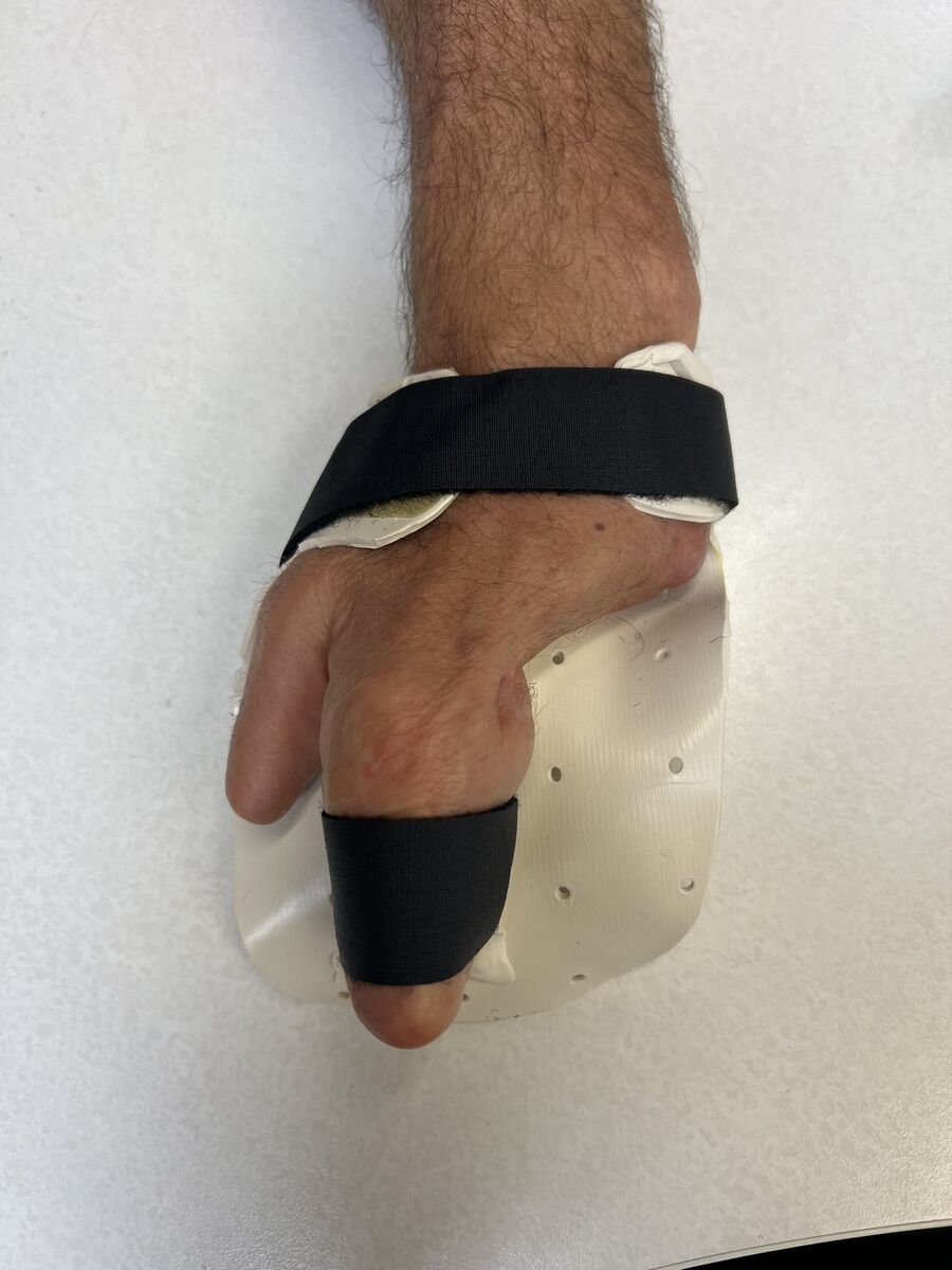 Custom hand orthosis example — thermoplastic splint made at Reach Beyond Therapy in Redondo Beach