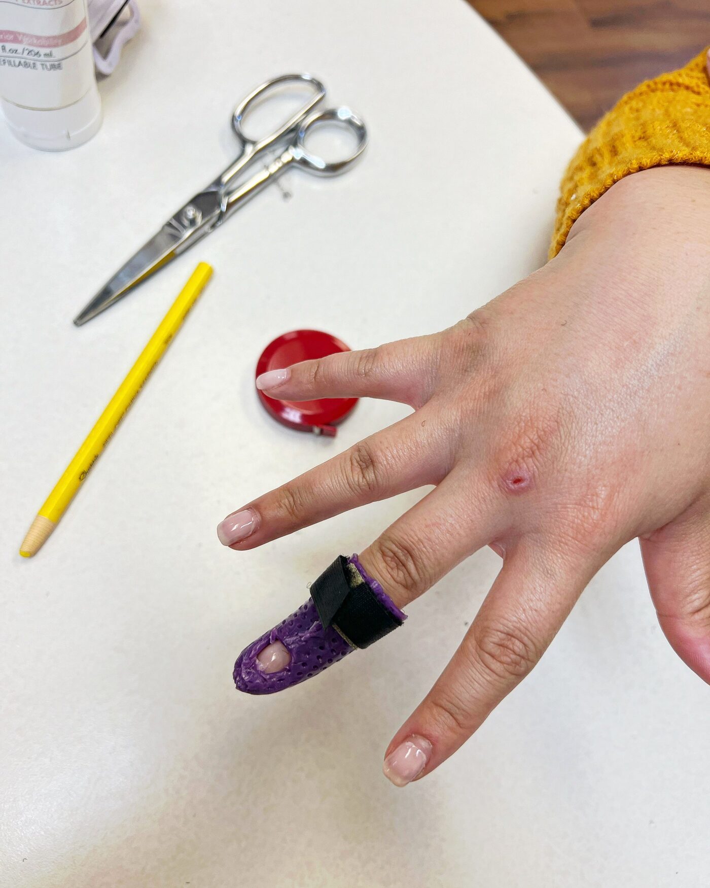Custom thermoplastic hand splint being fabricated on-site by a Certified Hand Therapist in Redondo Beach