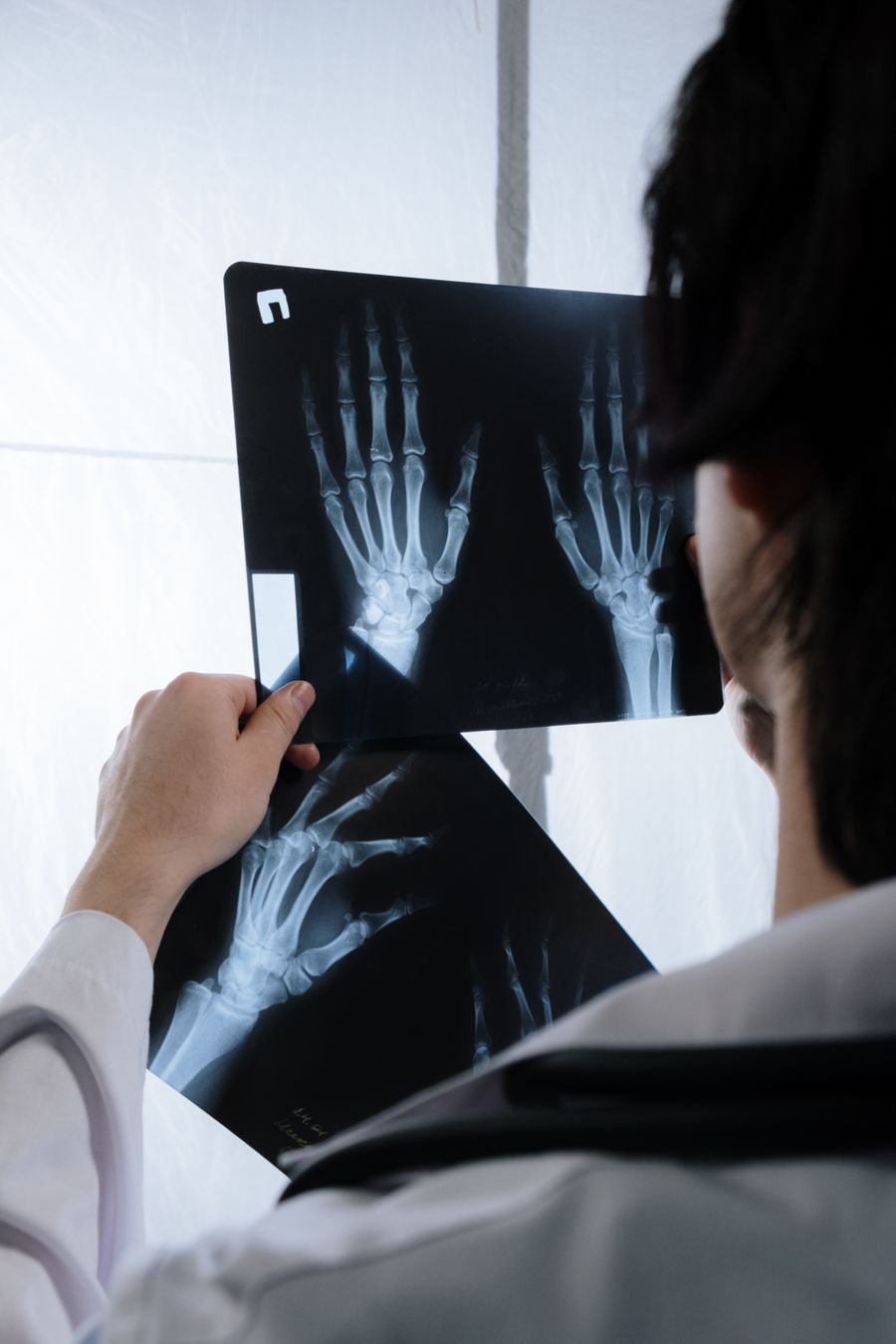 Doctor reviewing hand X-ray images to assess fracture healing and guide rehabilitation
